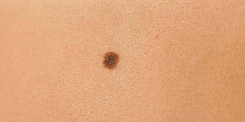 Bí Ẩn Nốt Ruồi Phong Thủy Và Vận Mệnh Chưa Có Lời Giải! 1 Hiểu đúng về nốt ruồi phong thủy và vận mệnh