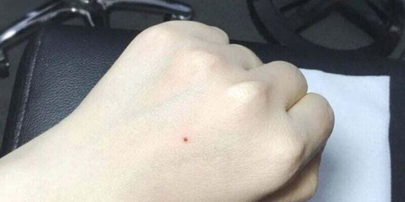 Ý Nghĩa Nốt Ruồi Son – Giải Mã Tài Lộc và Vận Mệnh tại SHBET 1 Nốt ruồi son và vận mệnh may mắn